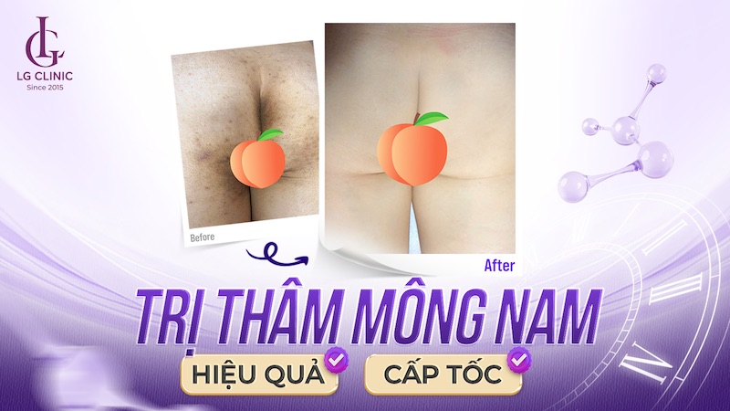 cách trị thâm mông nam