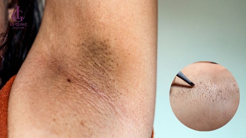Cách trị thâm và hôi nách