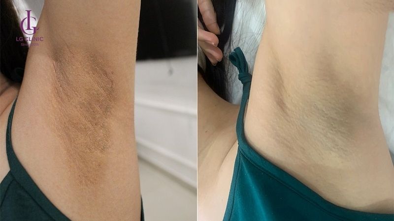 Cách trị thâm và hôi nách