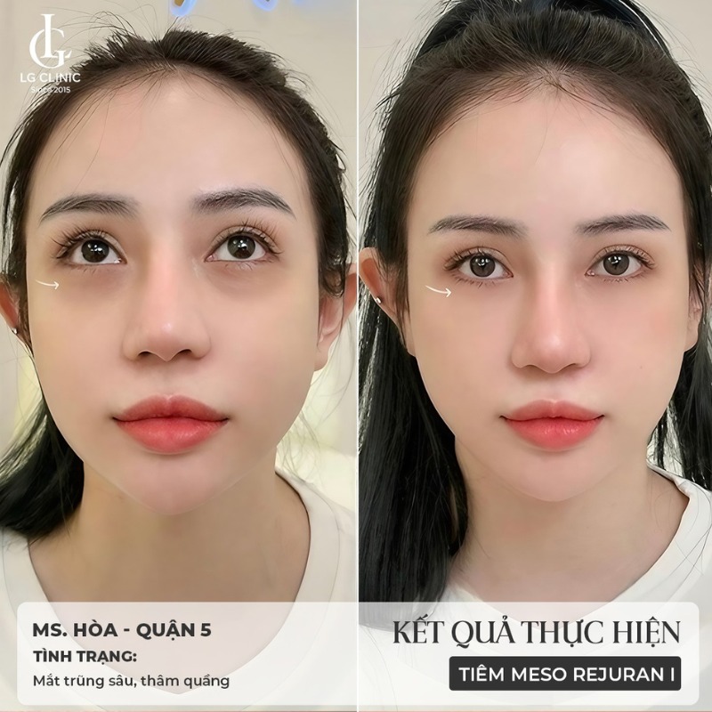 dầu dừa có trị thâm mắt không - tiêm trị thâm quầng mắt