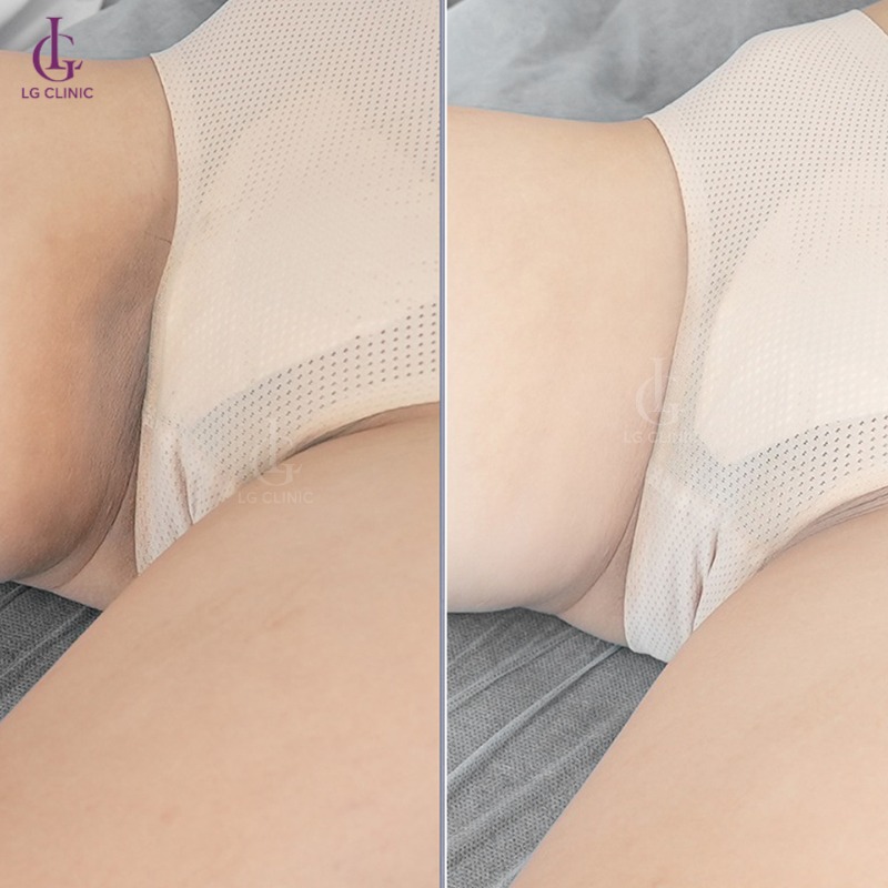 spa trị thâm bẹn - trị thâm háng ở đâu hiệu quả