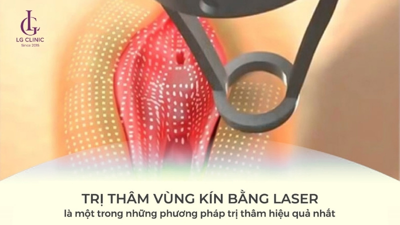 trị thâm vùng kín bằng laser - trị thâm cô bé