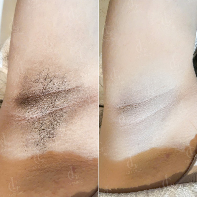 hình ảnh triệt lông nách