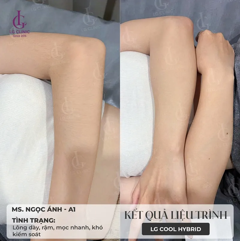 Hình ba triệt lông 01