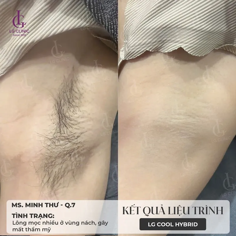 Hình ba triệt lông 02