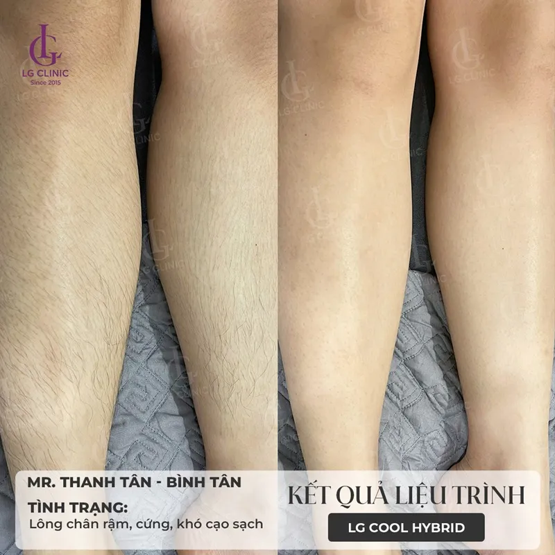Hình ba triệt lông 03