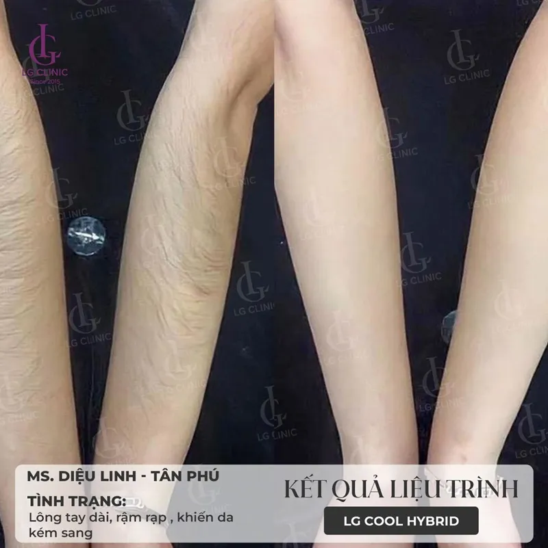 Hình ba triệt lông 04