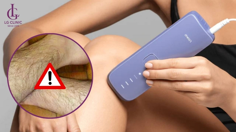 máy triệt lông tại nhà có hiệu quả không