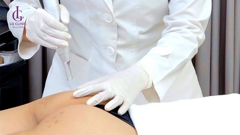 thâm mông có hết được không