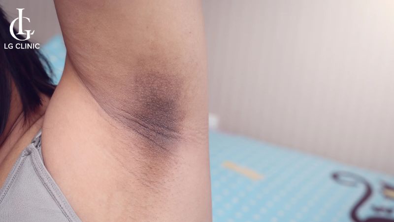 thâm nách sau sinh có tự hết không