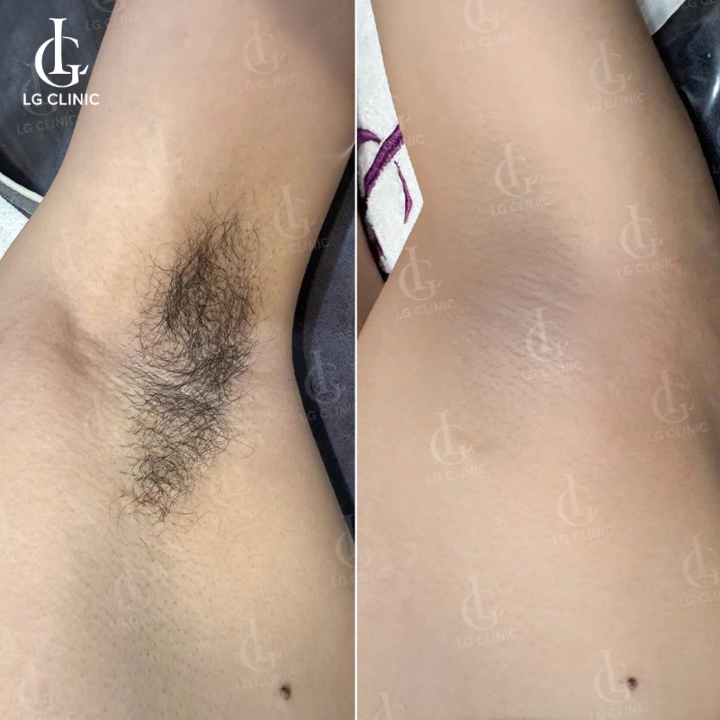 triệt lông nách nam