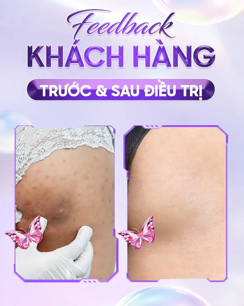 Ba ưu đãi trị thâm 04 1