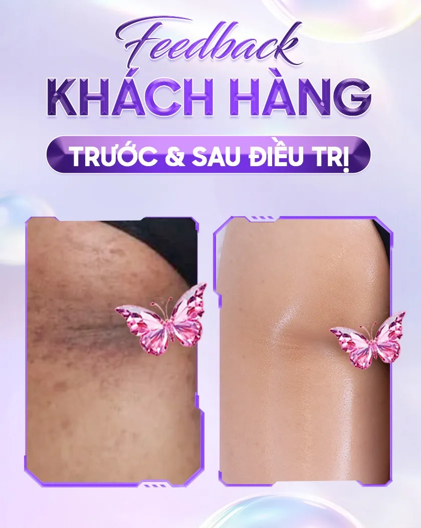 Ba ưu đãi trị thâm 06 1