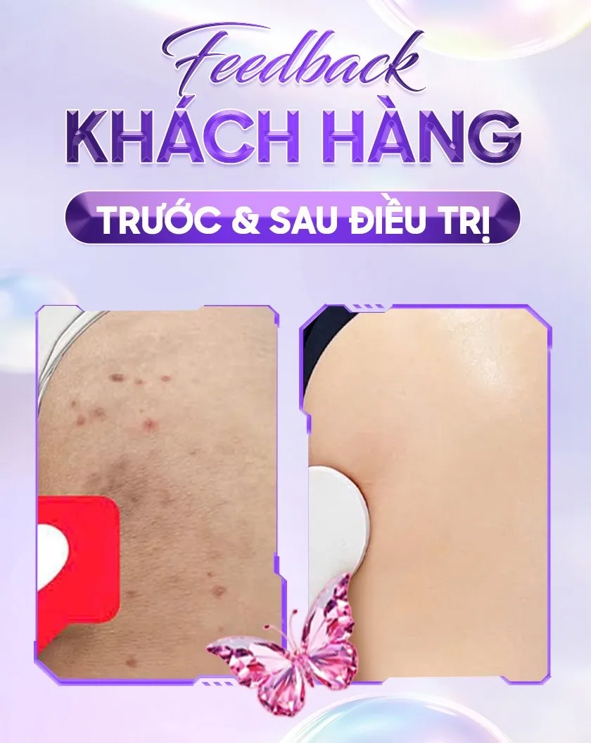 Ba ưu đãi trị thâm 10 1