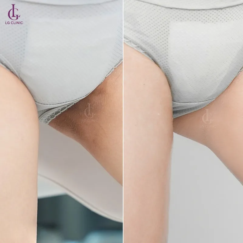 Hình ảnh trị thâm bẹn