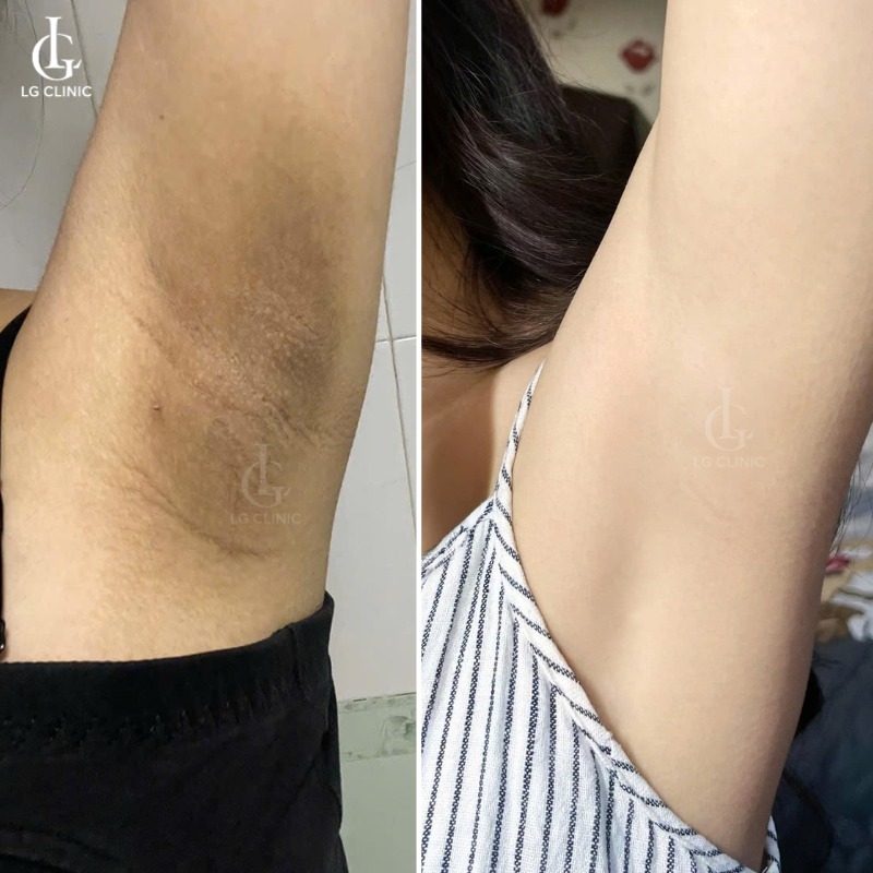 nách bị thâm đen là bệnh gì
