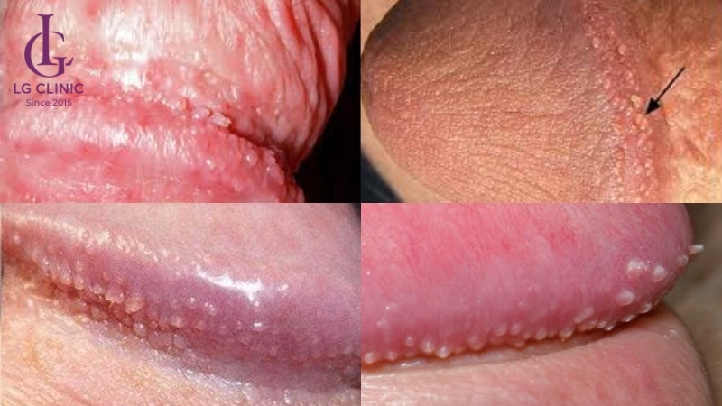 Chuỗi hạt ngọc dương vật