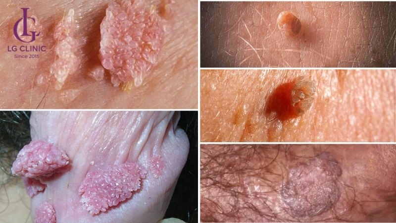 mụn thịt do sùi mào gà vùng kín nam