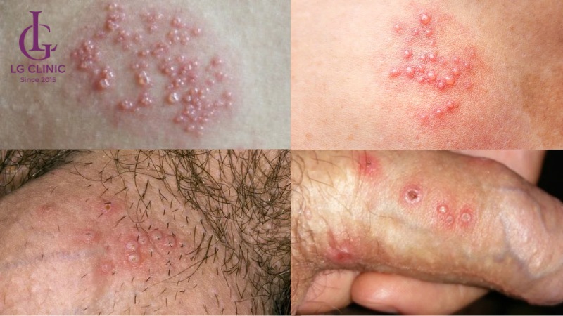 Mụn rộp sinh dục