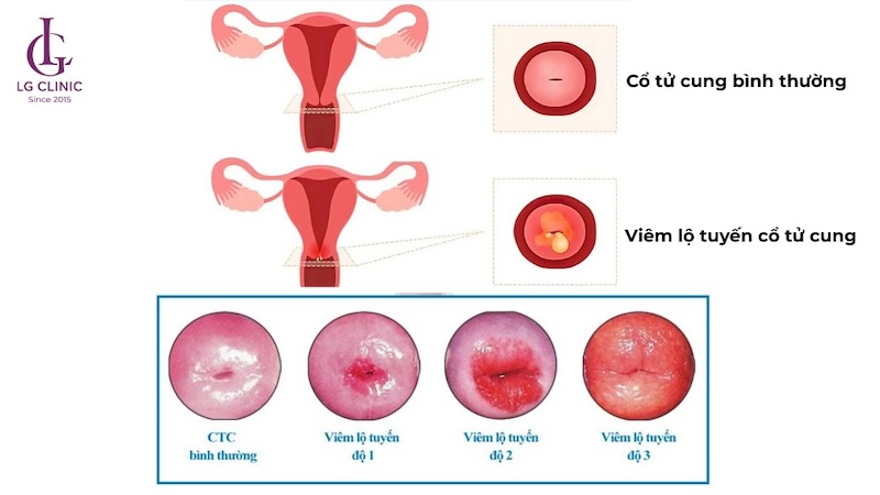 Viêm lộ tuyến