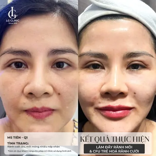 BA điều trị cfu