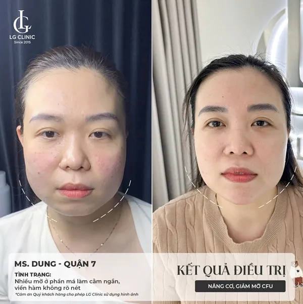 BA điều trị cfu