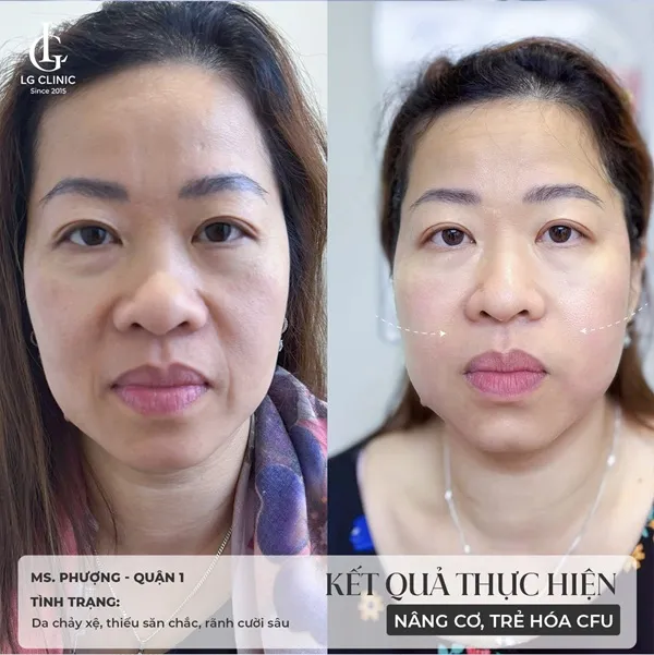 BA điều trị cfu