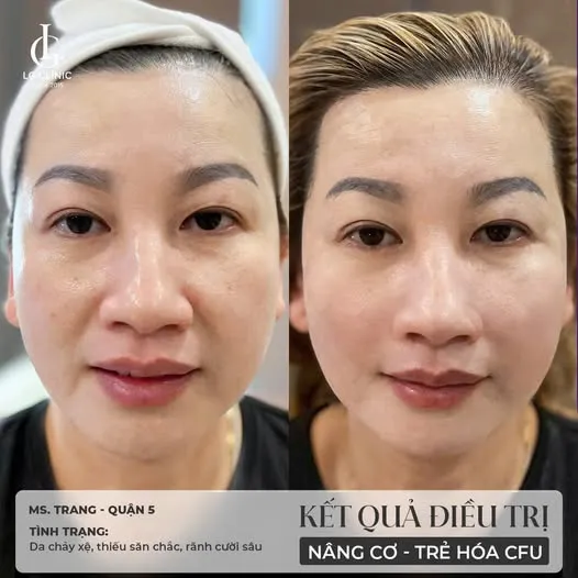 BA điều trị cfu