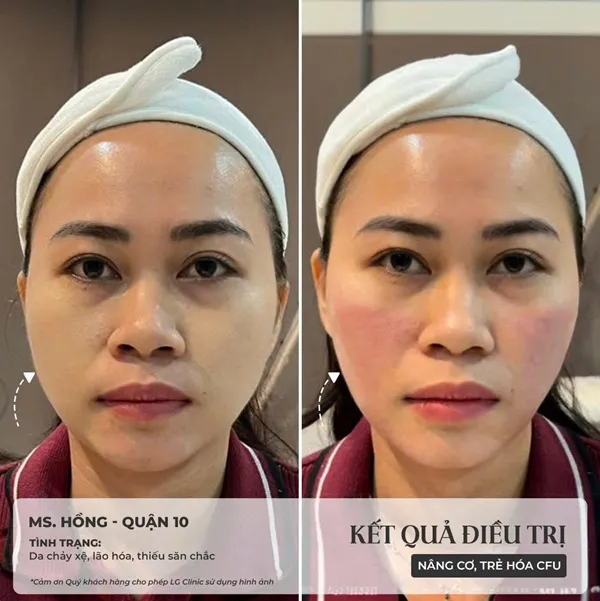 BA điều trị cfu