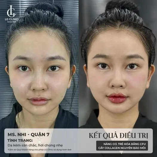 BA điều trị cfu