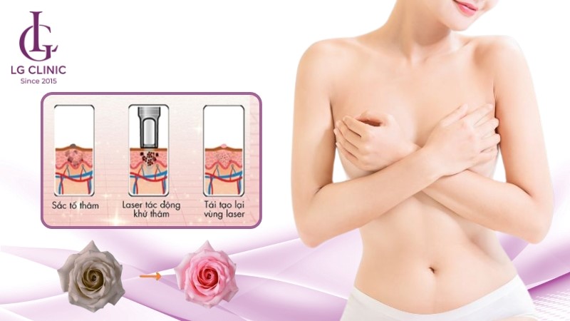 có nên làm hồng nhũ hoa không
