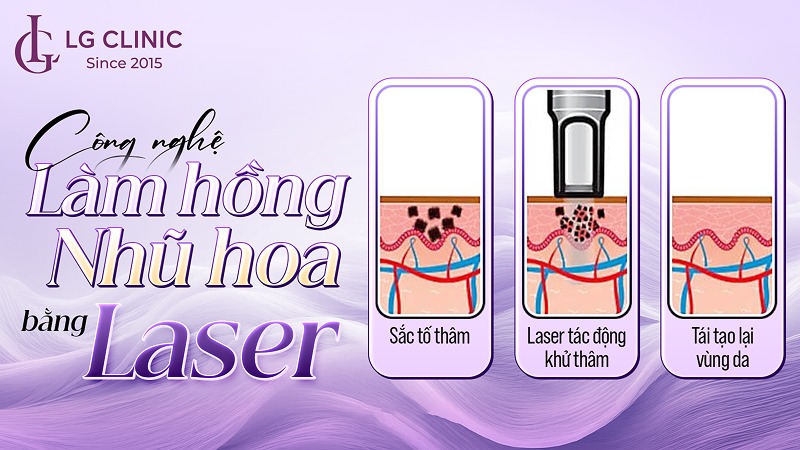 làm hồng nhũ hoa bằng laser