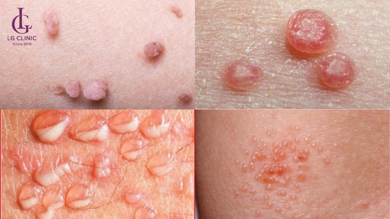 ngứa vùng kín nữ giới do bệnh xã hội