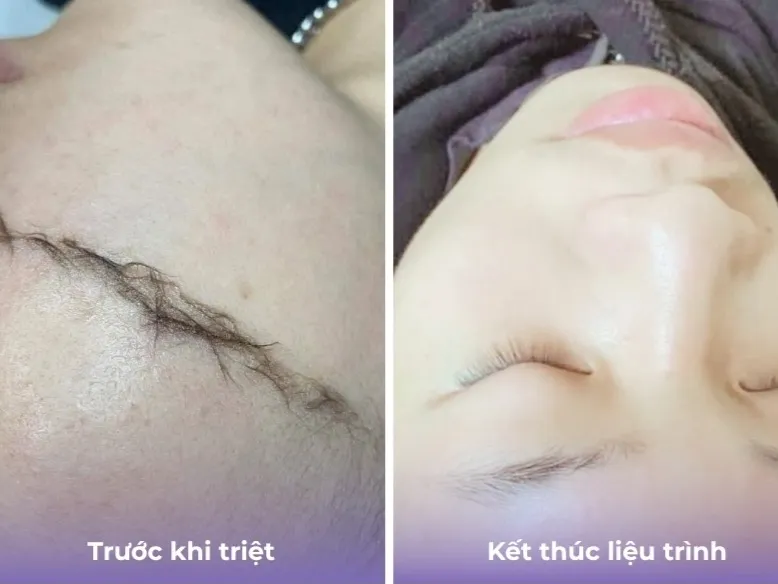 Hình ba triệt lông mặt 01
