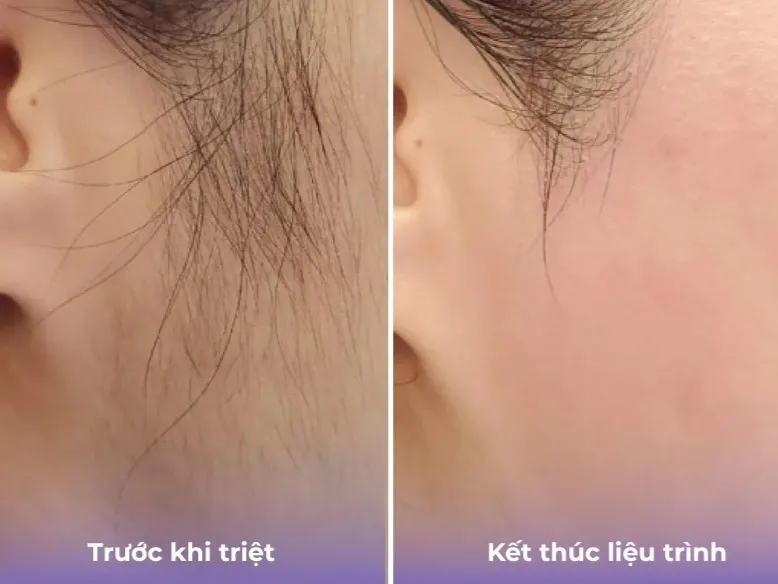 Hình ba triệt lông mặt 02
