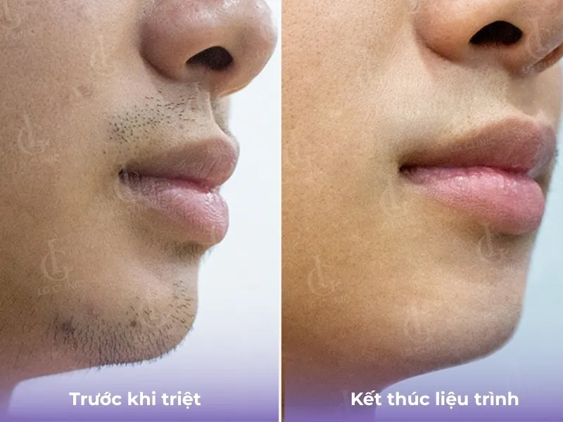 Hình ba triệt lông mặt 03