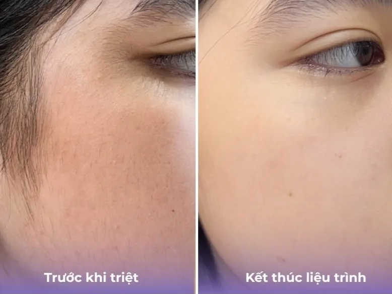 Hình ba triệt lông mặt 04