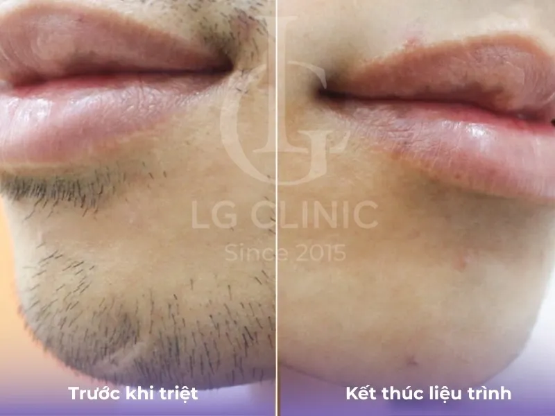 Hình ba triệt lông mặt 05