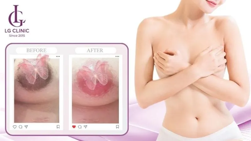 làm hồng nhũ hoa bằng laser