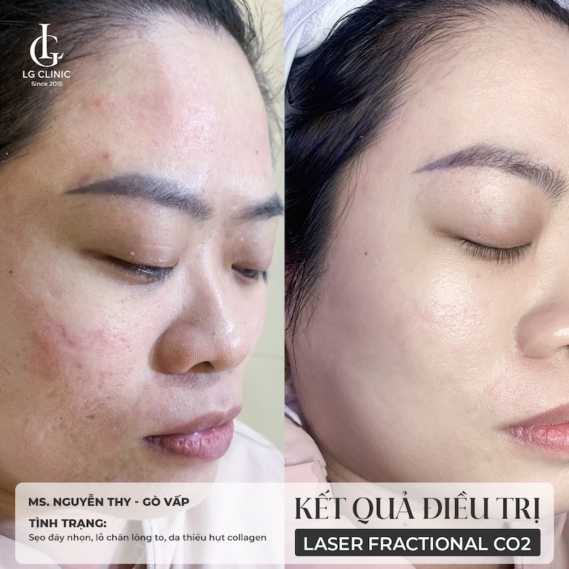 kết quả trẻ hoá da bằng laser co2