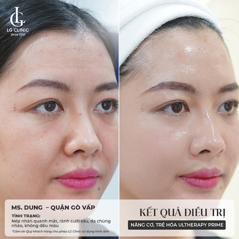 nâng cơ ultherapy prime