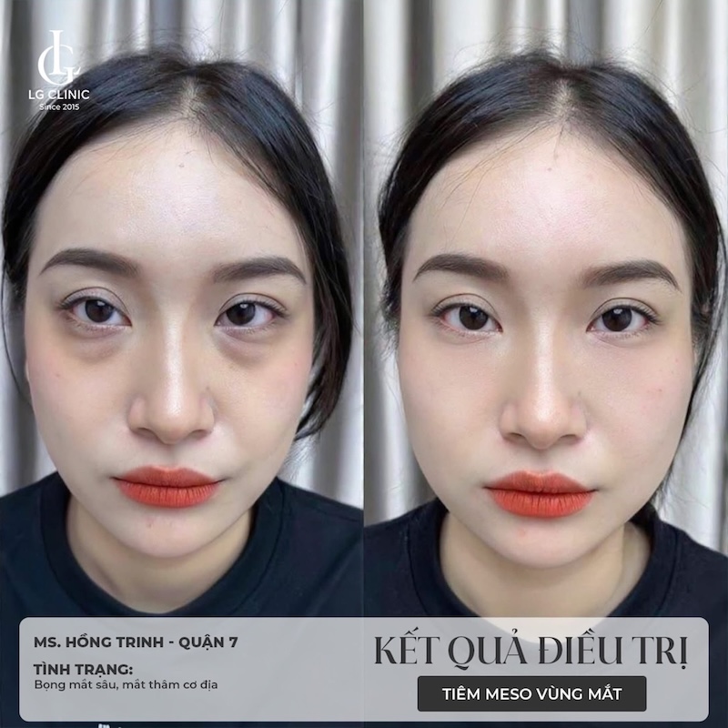trị thâm mắt