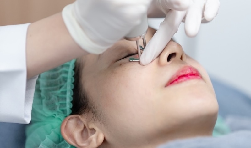 laser trị thâm mắt