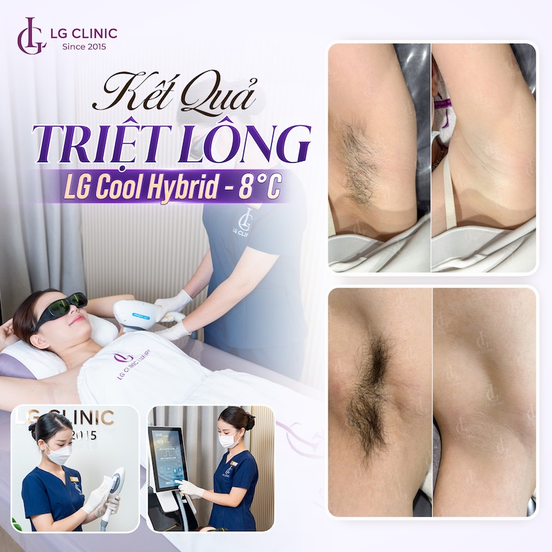 triệt lông nách