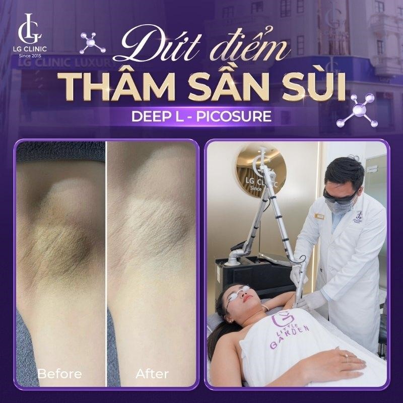 trị thâm nách bằng laser
