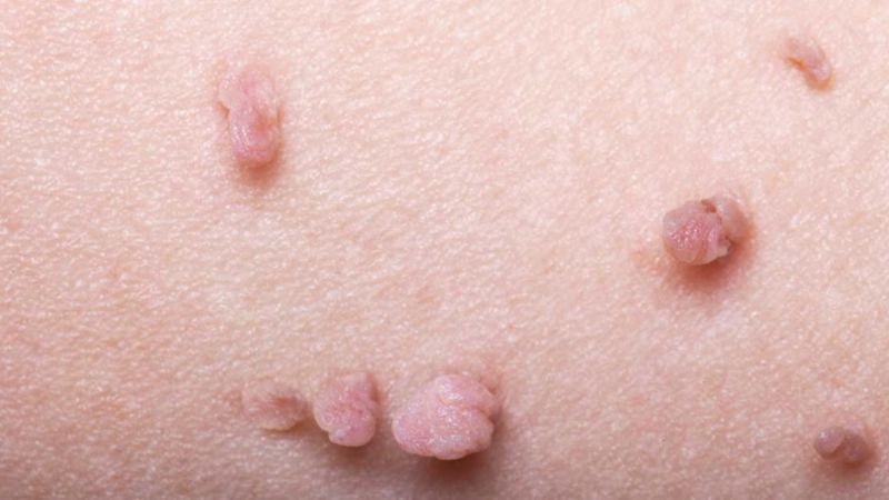 mụn thịt mọc ở vùng kín