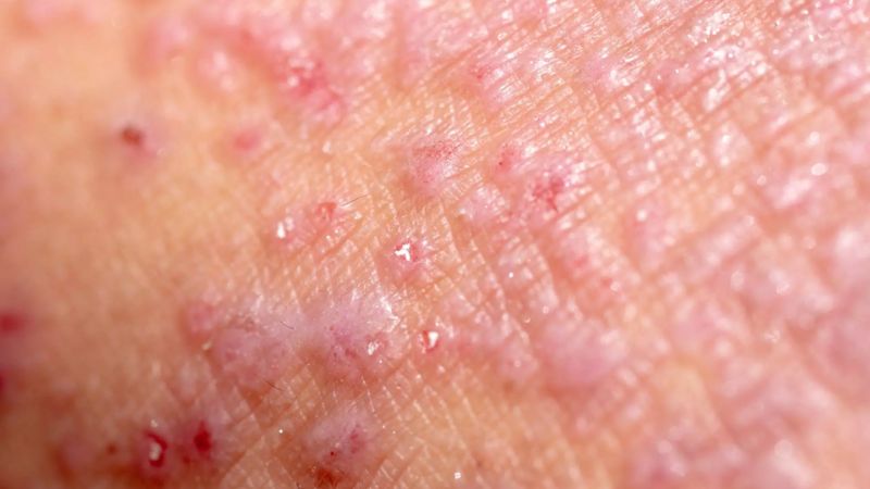mụn nhỏ li ti mọc ở vùng kín