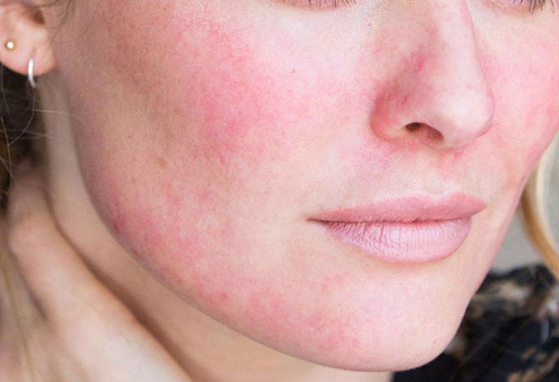 theo dõi tình trạng da sau khi làm ultherapy