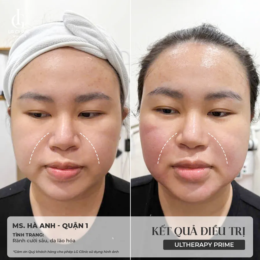 Hình ảnh ba Ultherapy Prime 01