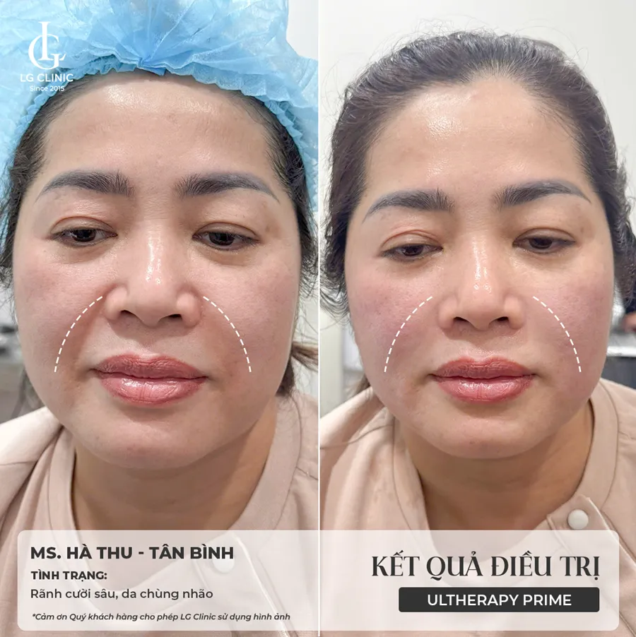 Hình ảnh ba Ultherapy Prime 02